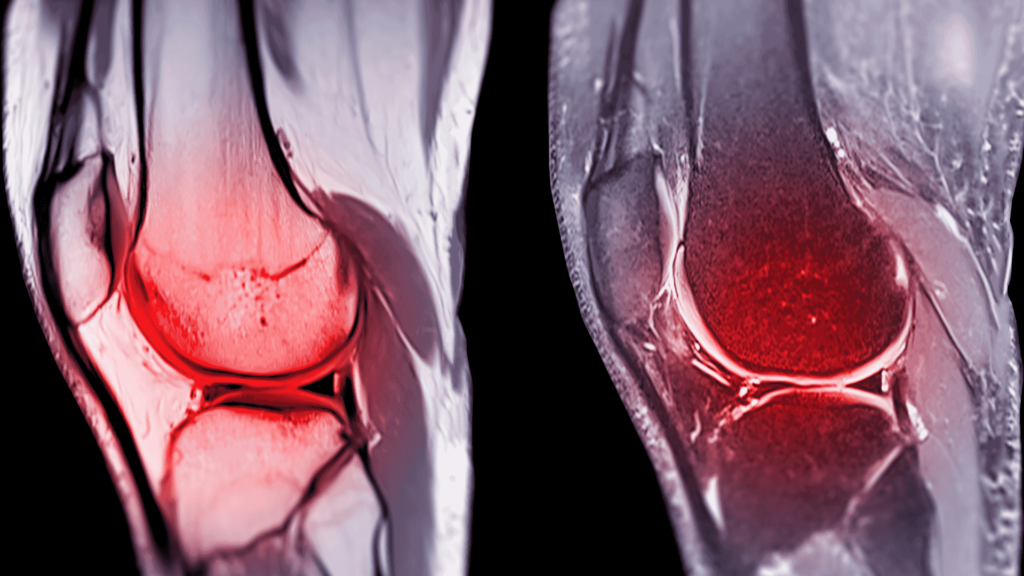 Lesão do Ligamento Cruzado Anterior | Dr. Guilherme Alvim | Ortopedista