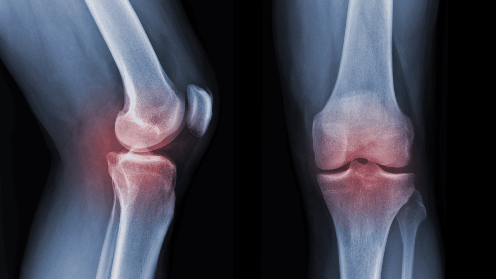 Células-Tronco e Biológicos | Dr. Guilherme Alvim | Ortopedista