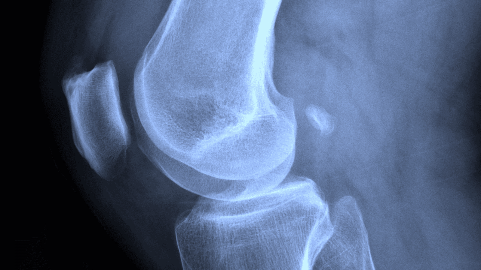 Joelhos Valgos e Varos | Dr. Guilherme Alvim | Ortopedista