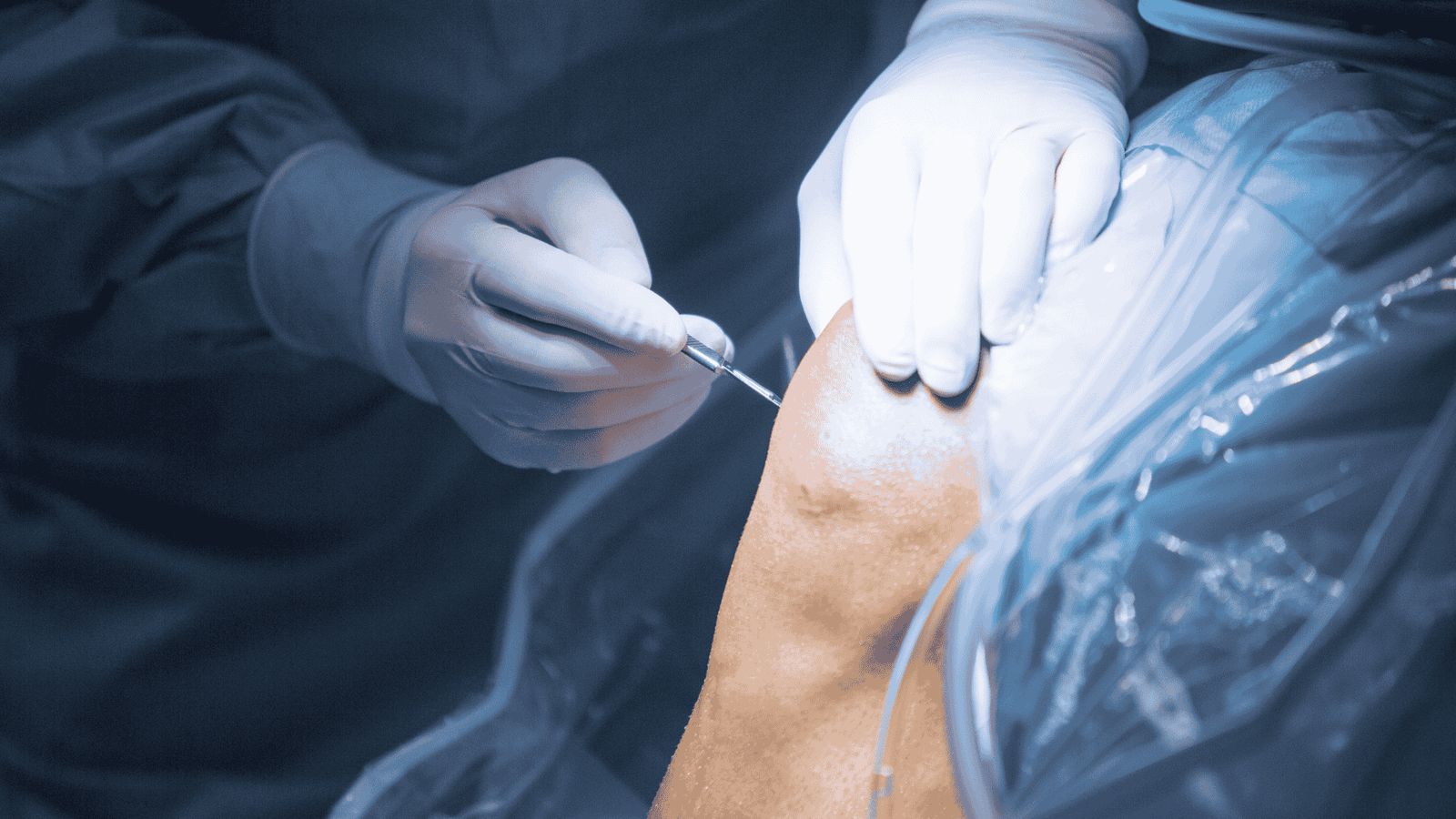 Artroscopia do Joelho | Dr. Guilherme Alvim | Ortopedista